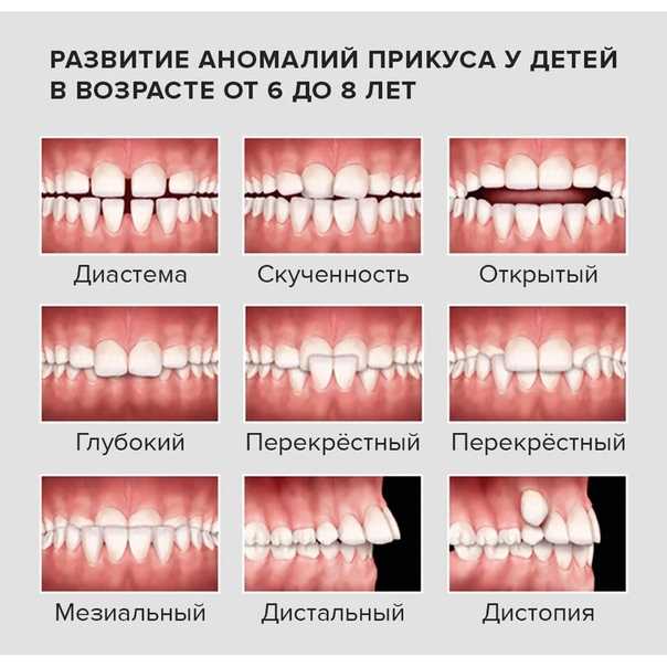 Исправление прикуса у детей: это должны знать все родители ⋆ orthogid.ru