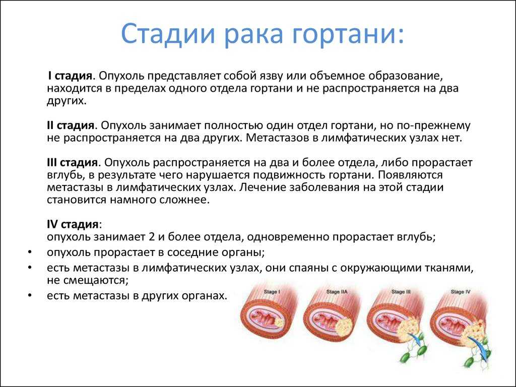 Рак горла и гортани — диагностика и лечение