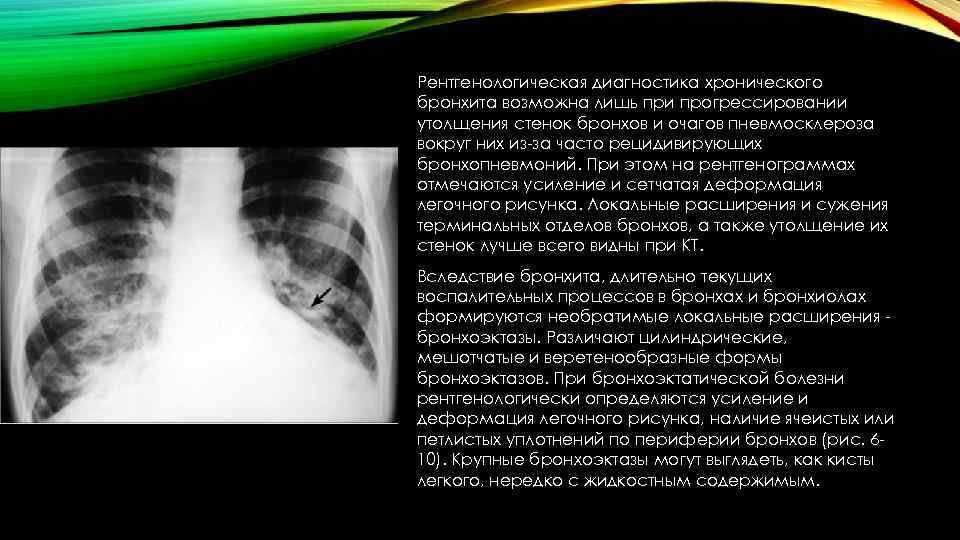 Что такое усиление легочного рисунка на рентгене?