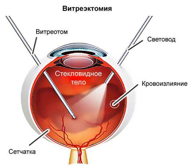 С какой целью проводится витрэктомия?