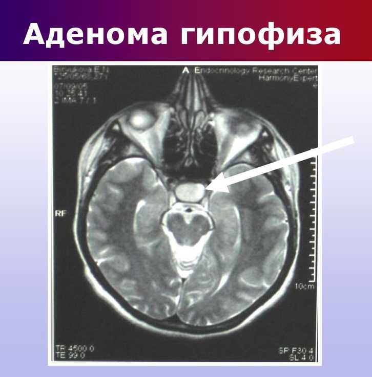Аденома гипофиза – симптомы и лечение - медком
