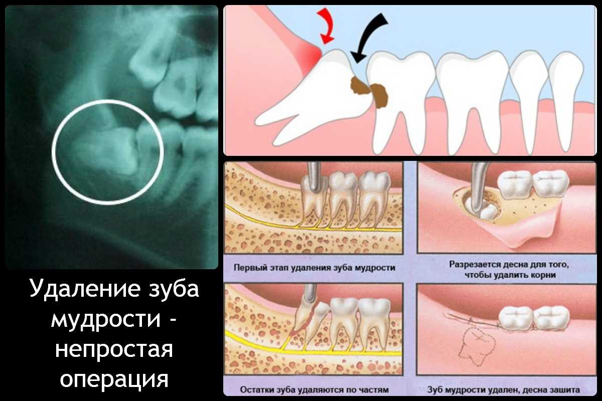 Отсутствие зубов мудрости в полости рта