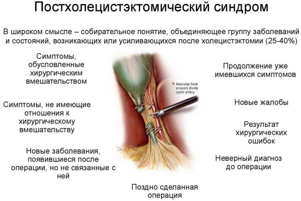 Гиперэхогенное образование в яичнике: что это?