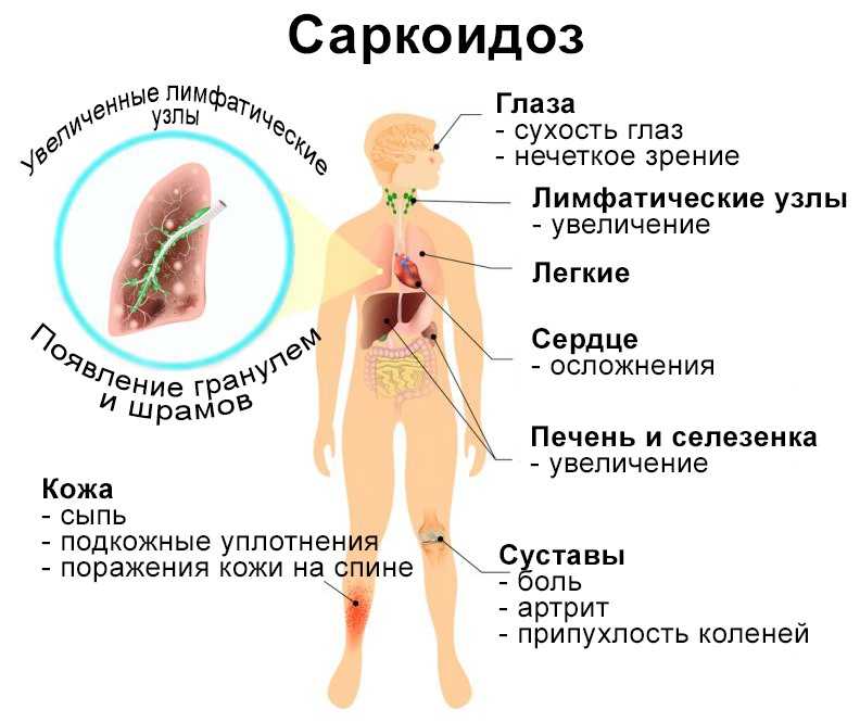 Саркоидоз. причины, симптомы, лечение саркоидоза легких.!