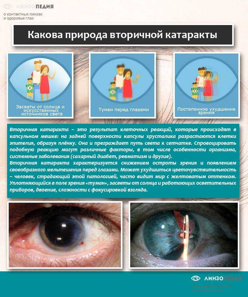 Операция для удаления катаракты - энциклопедия ochkov.net