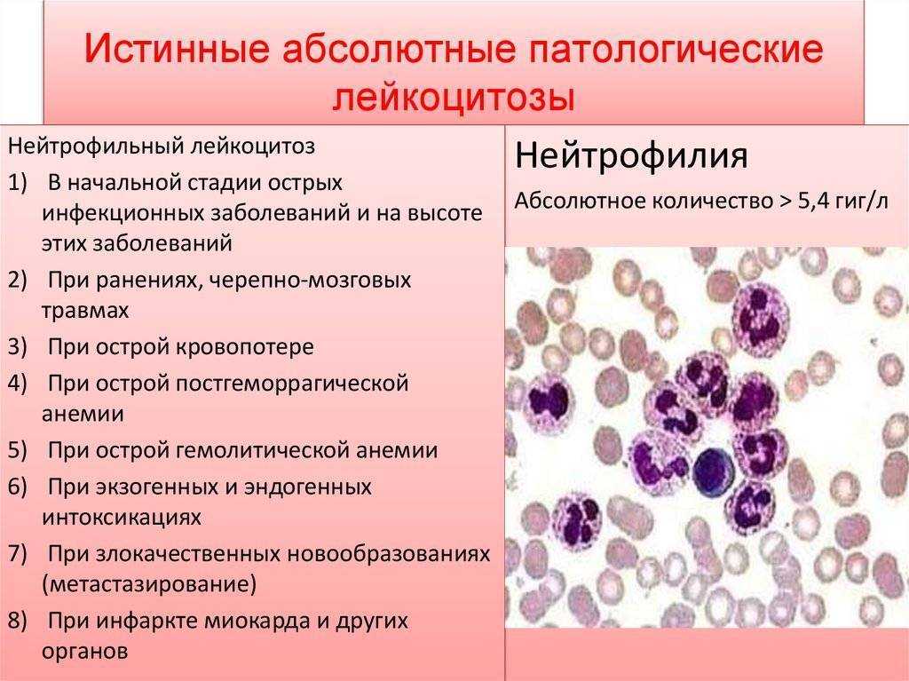 Хронический лейкоцитоз. Степени лейкоцитоза.