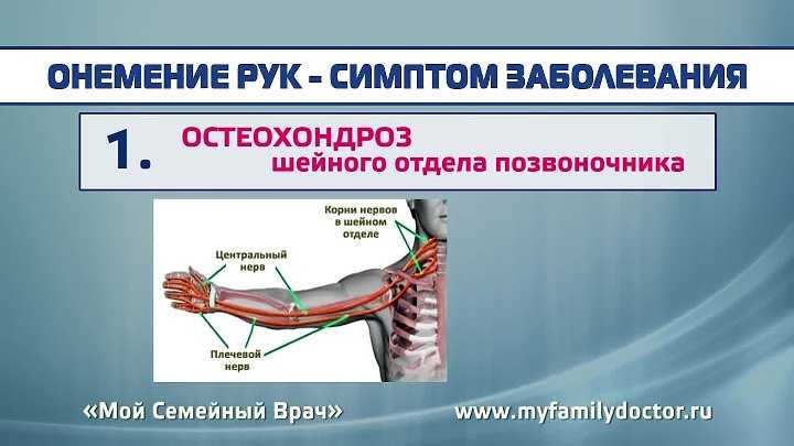 Инсульт: симптомы и первые признаки инсульта | университетская клиника