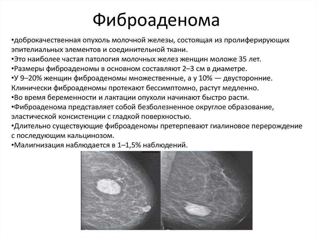 Рак молочной железы (рак груди)