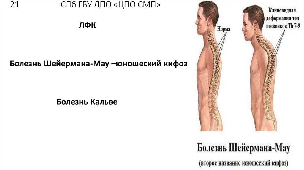 Кифоз грудного отдела степени