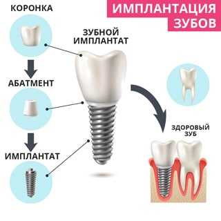 Как устанавливаются импланты зубов пошагово с фото