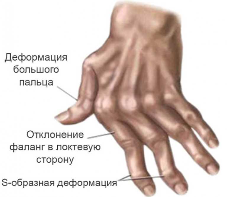 Ревматоидный артрит