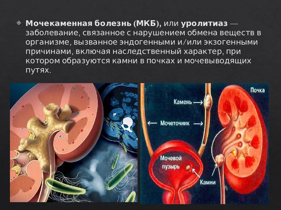 Мочекаменная болезнь — причины, симптомы и лечение мкб | фитолизин