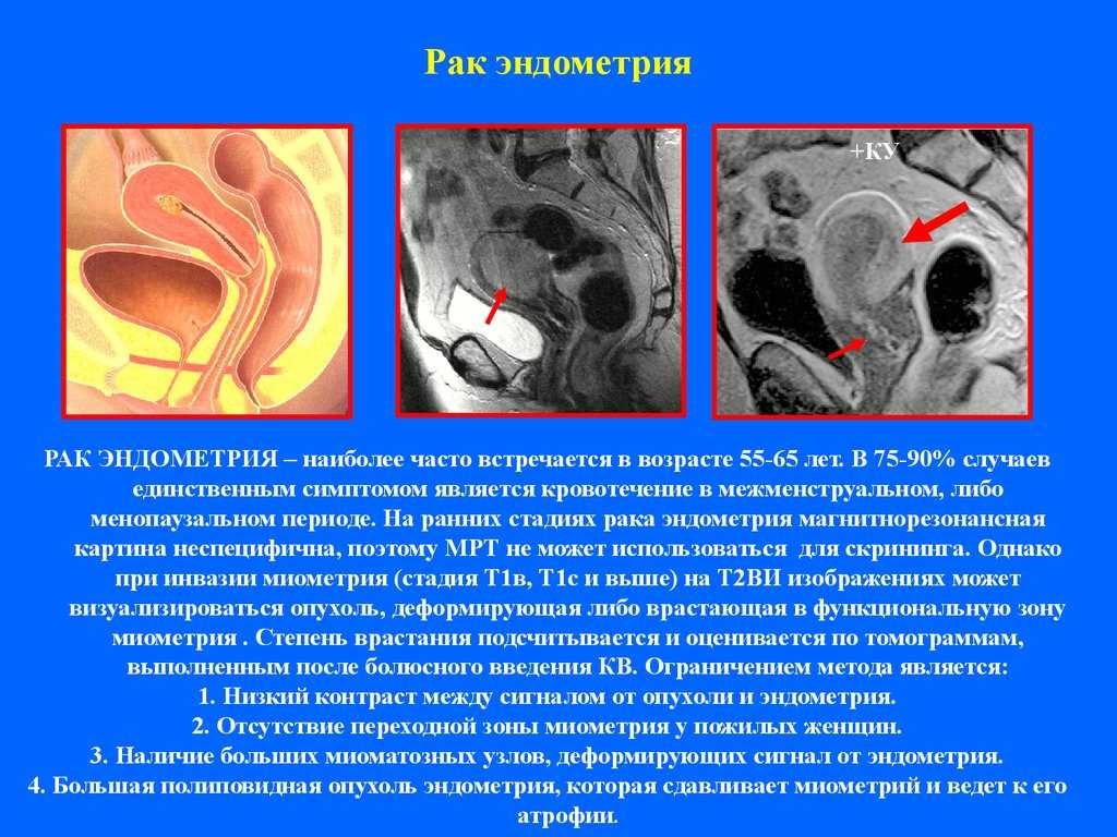 Рак матки: симптомы, на которые нужно реагировать * клиника диана в санкт-петербурге