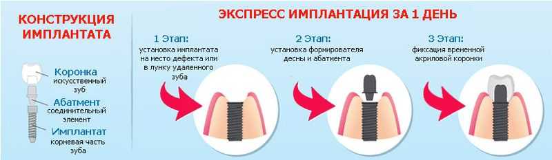 Технология имплантации зубов: этапы