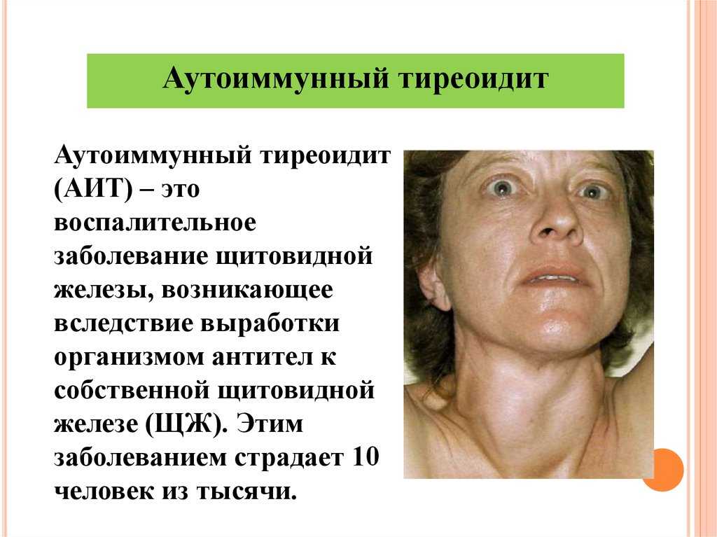 Болезнь хашимото: причины, симптомы, лечение
