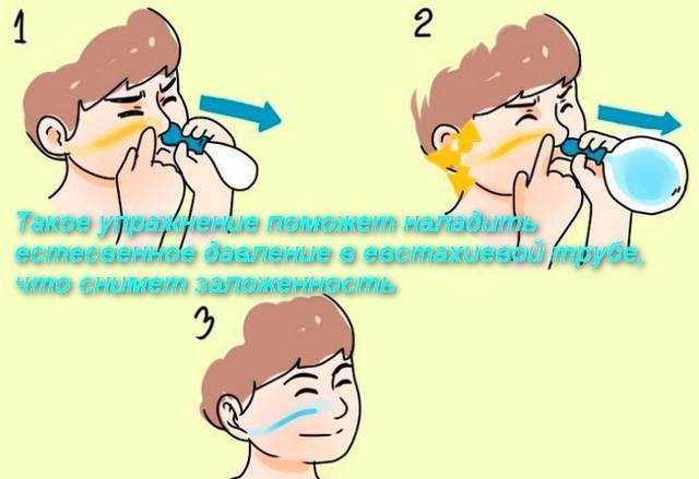 Воздушная болезнь