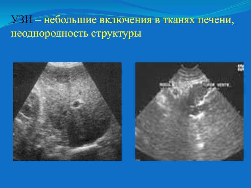 Неоднородная структура. Неоднородная структура печени на УЗИ. УЗИ печени эхоструктура. Неоднородность печени на УЗИ.