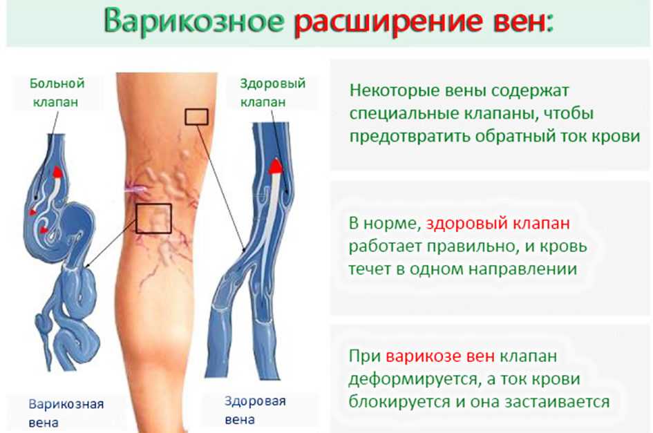 Самое эффективное средство от варикоза на ногах, список лучших препаратов