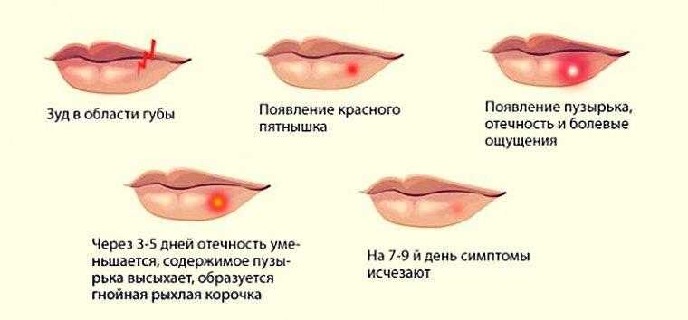 Герпес после увеличения губ
