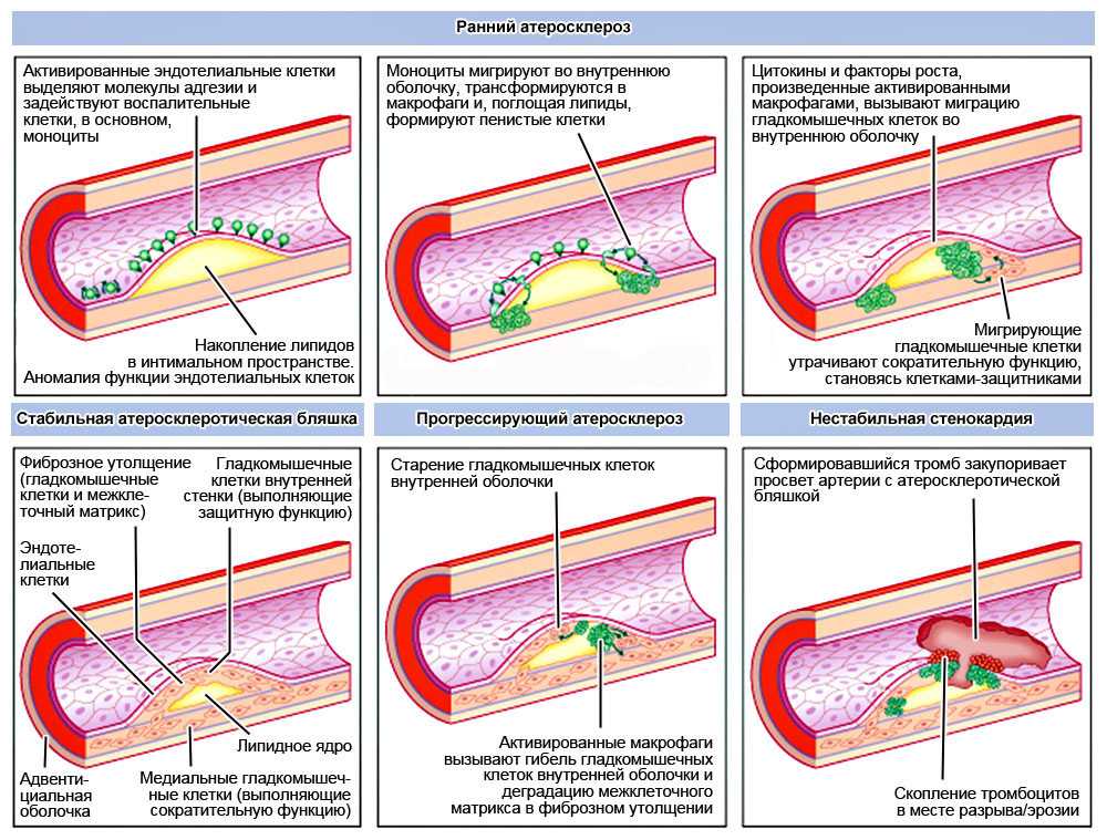 Атеросклероз 2 типа. Стадии атеросклеротического процесса. Этапы образования атеросклеротической бляшки. Стадии формирования атеросклероза. Процесс формирования атеросклеротической бляшки.