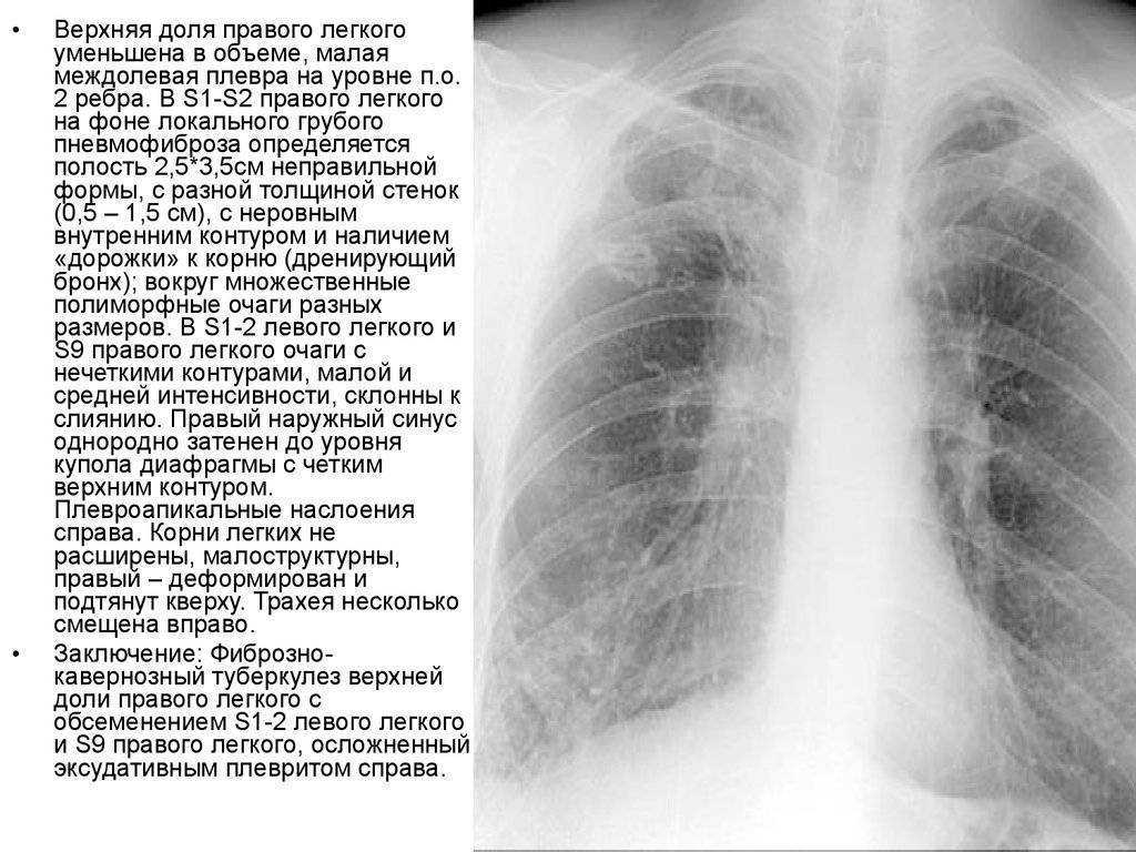 Легочный рисунок с признаками пневмосклероза что это значит у женщин