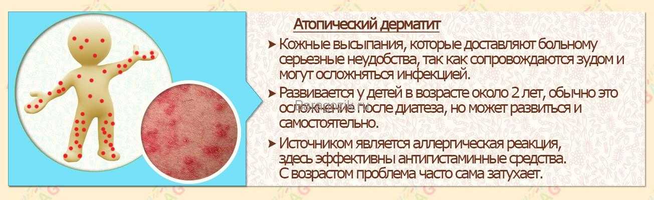 Холодовая аллергия: как проявляется реакция на холод, чем ее лечить