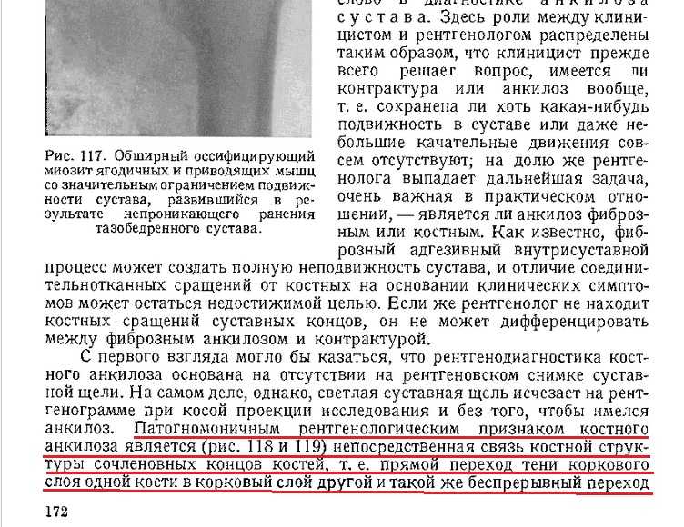 Анкилоз сустава. Анкилоз коленного сустава рентген описание. Анкилоз тазобедренного сустава рентген протокол описание. Анкилоз коленного сустава рентген. Анкилоз тазобедренного сустава.