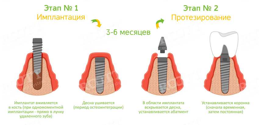 Имплантация схема установки зубов