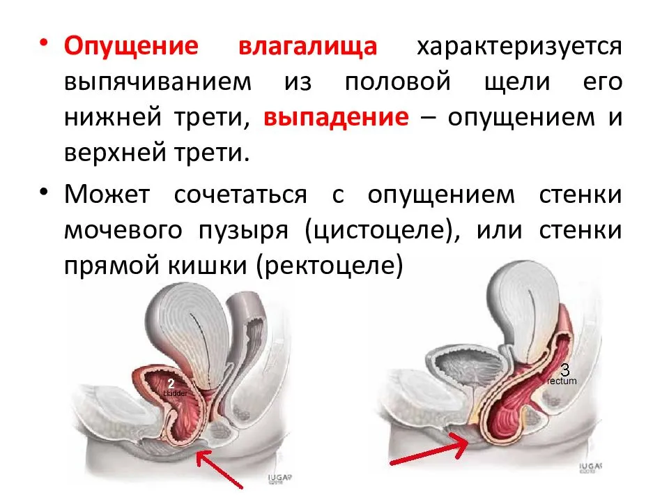 Опущение стенок матки симптомы и лечение и фото как это выглядит