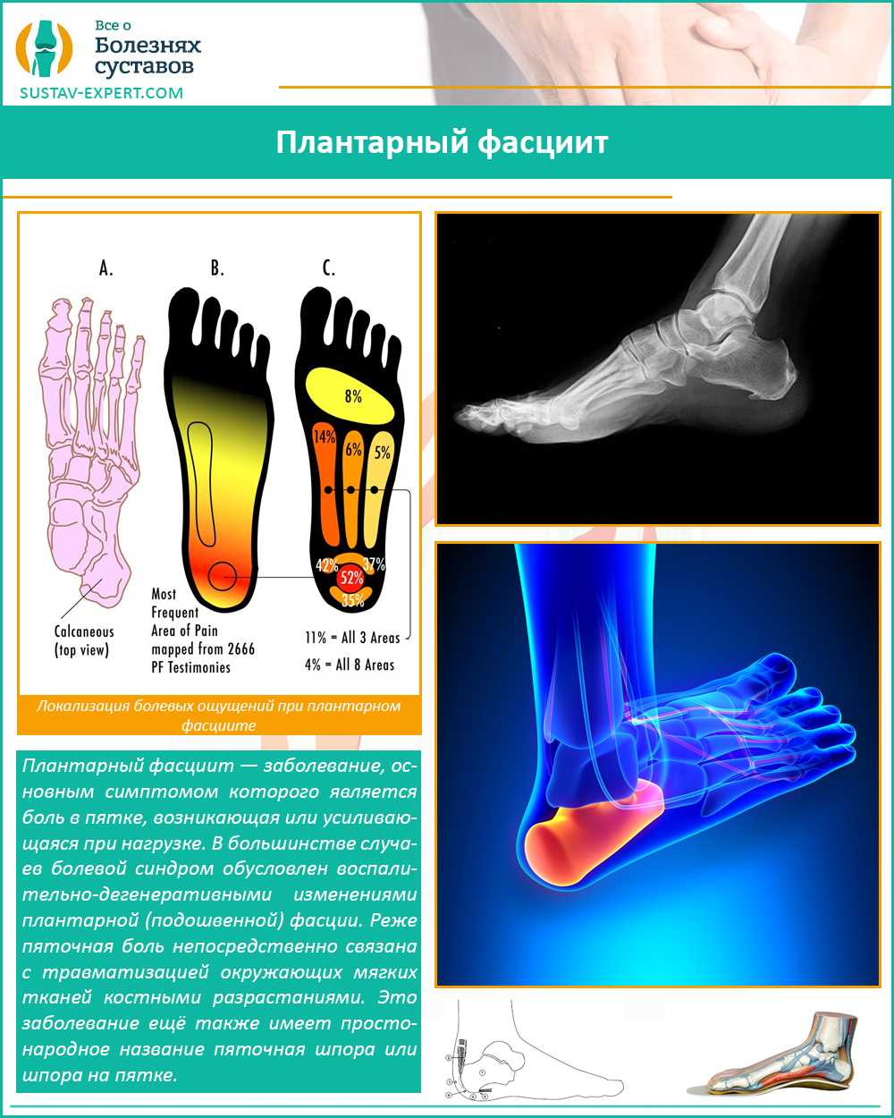 Плантарный фасциит стопы картинки