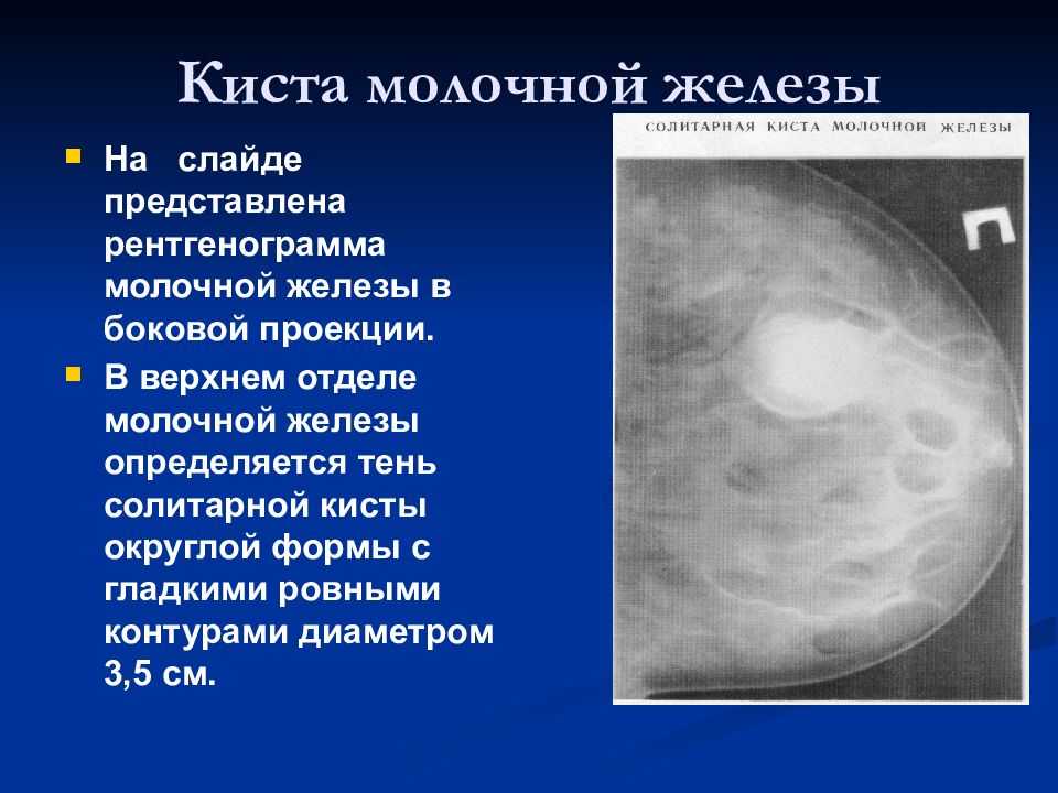 Киста молочной. Кисты в молочных железах. Косты в солочных железах. Киста правой молочной железы.