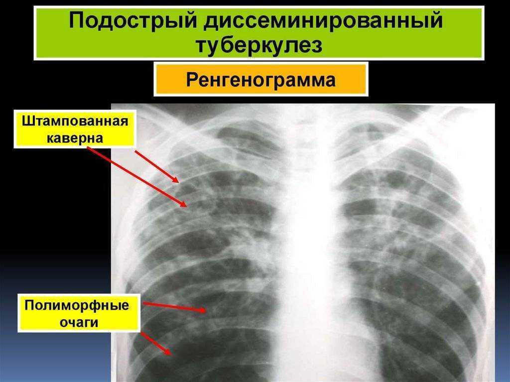 Симптомы легкого течения. Подострый диссеминированный туберкулез рентген. Милиарный диссеминированный туберкулез рентген. Хронический диссеминированный туберкулез рентген. Диссеминированный туберкулезентген.