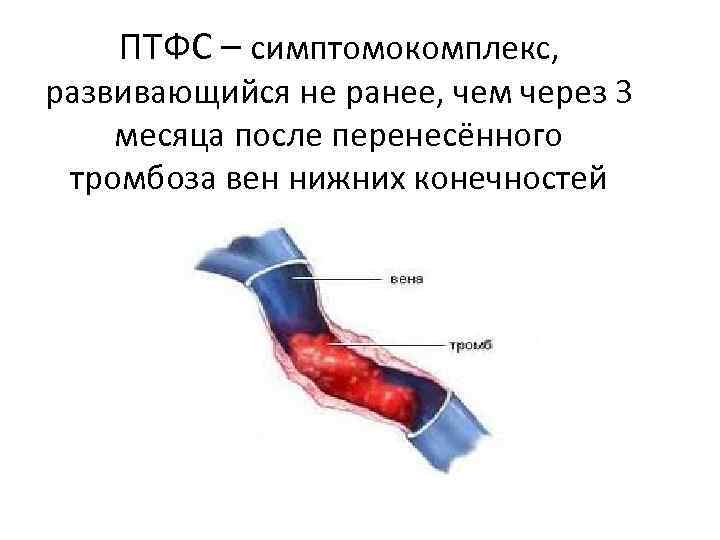 Тромбофлебит