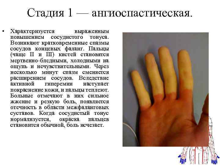 Феномен рейно: почему белеют пальцы