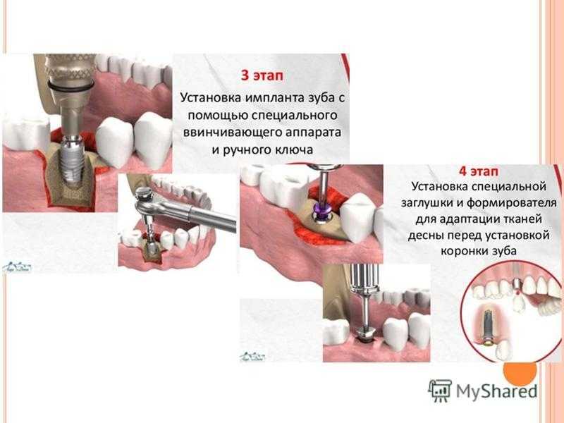 Имплантация схема установки зубов