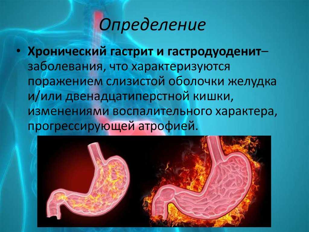 Гастрит желудка симптомы. Хронический гастрит и гастродуоденит. Гиперпластический гастродуоденит. Нодулярный гастродуоденит. Гастрит и гастродуоденит.