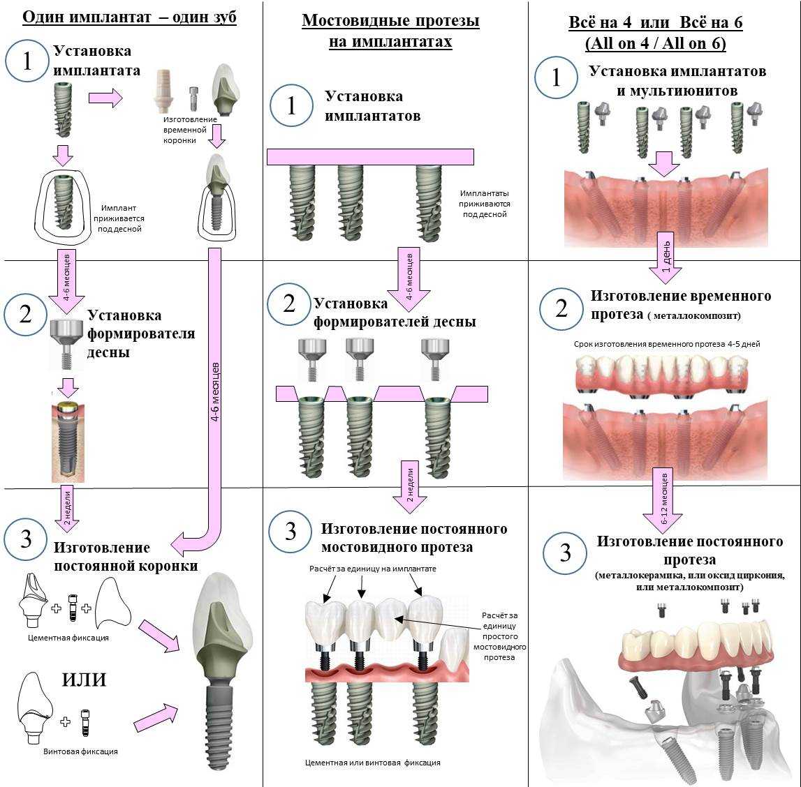 Этапы имплантации зубов схема