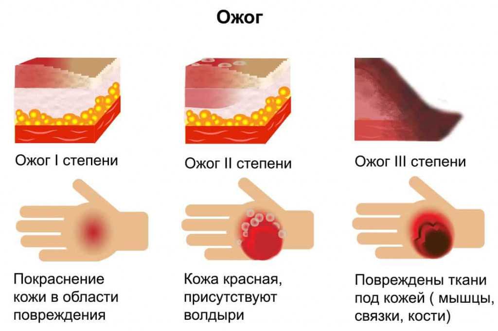 Аллергия на солнце? это не повод отказываться от отпуска!