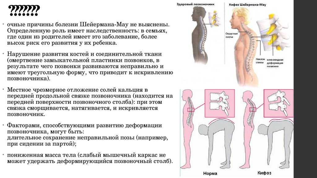 Заболевание позвоночника причины