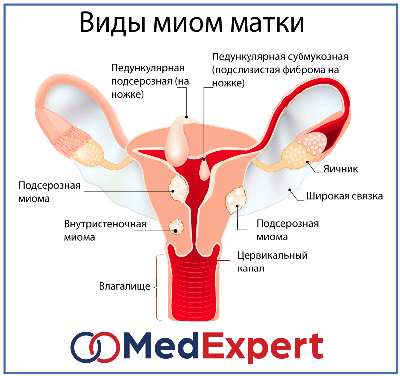 Какая бывает миома матки у женщин. Симптомная миома матки. Миомы матки расположение. Локализация миомы матки. Основные клинические проявления миомы матки.