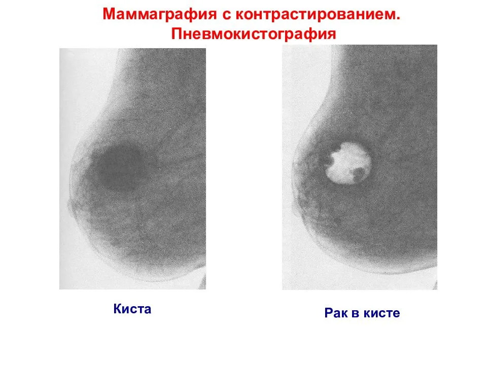Киста молочной железы: диагностика, лечение, операция