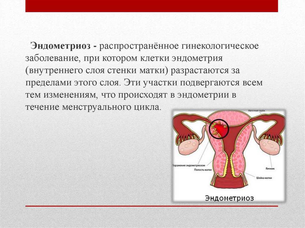 Эндометриоз матки что это. Гинекологическое заболевание эндометриоз.