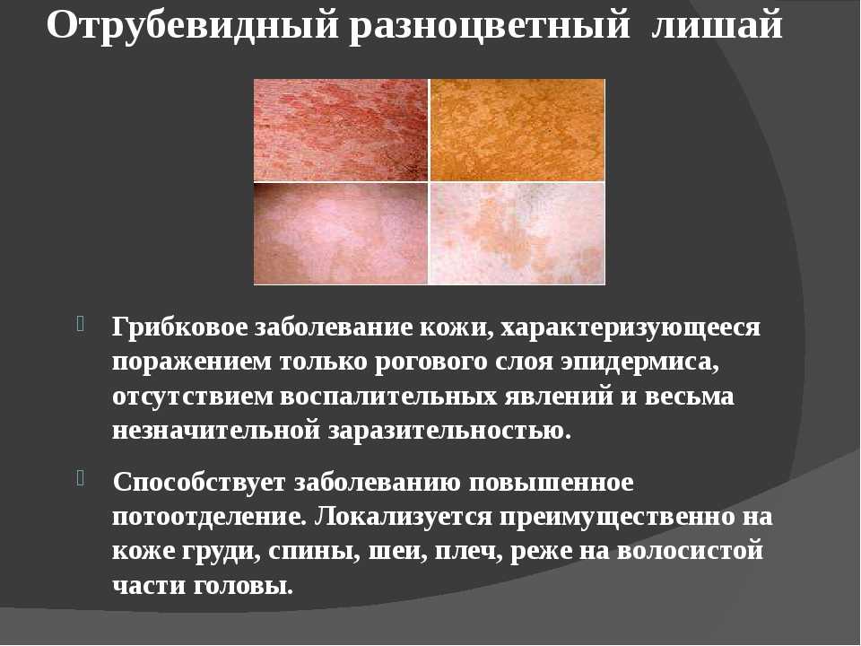 Чем лечить лишай? ~ советы специалистов