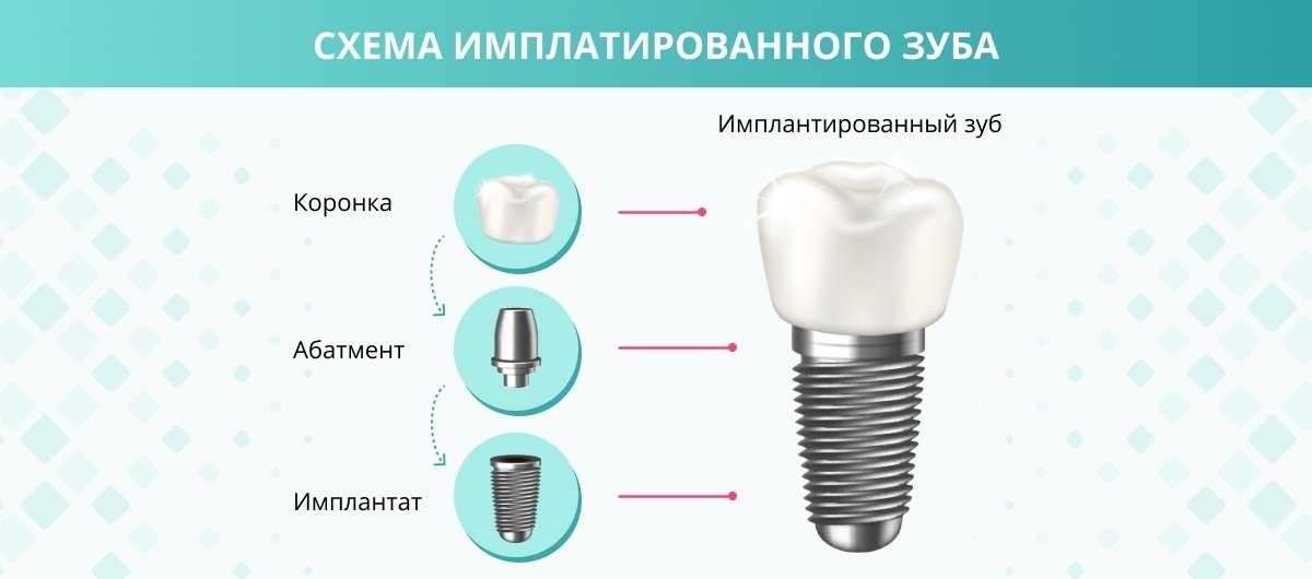 Этапы имплантации зубов и их особенности