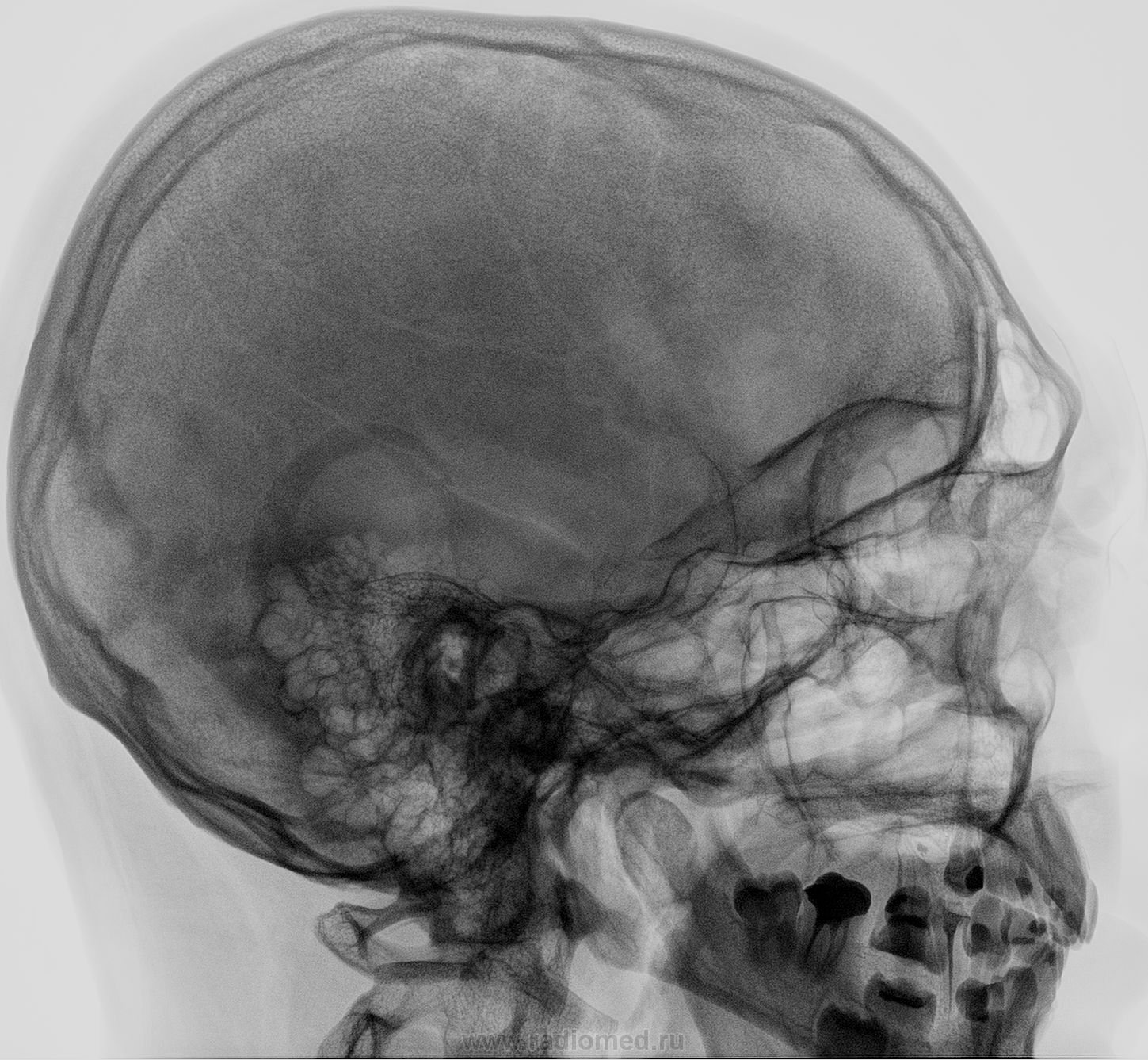 Проекции рентгенограммы. Рентгенография черепа (краниография. Гиперостоз костей черепа рентген. Рентгеноанатомия костей черепа. Снимок черепа сбоку рентген.