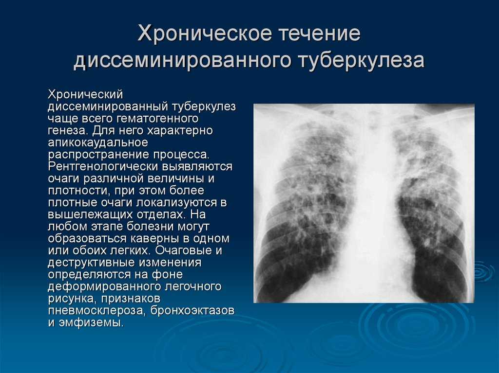 Симптомы легкого течения. Хронический диссеминированный туберкулез легких рентген. Хроническиеюц диссеминированный туберкулёз. Лимфогенно диссеминированный туберкулез рентген. Острый диссеминированный туберкулез рентген.