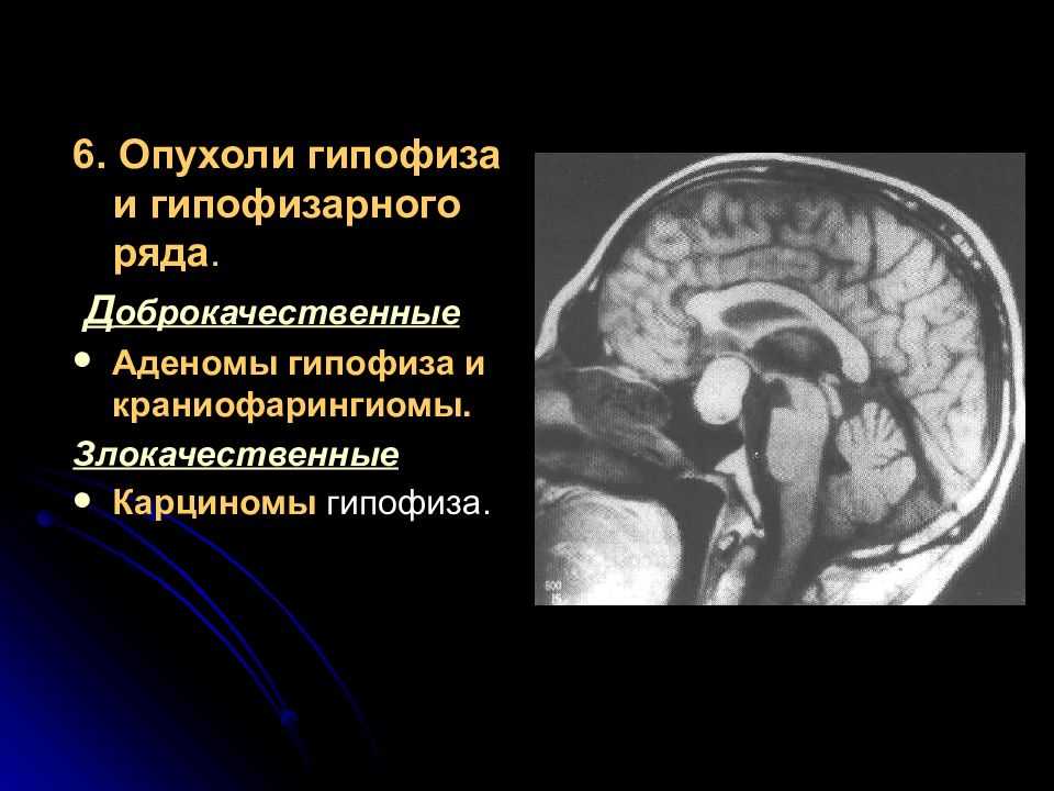 Осложнения после хирургического лечения аденом гипофиза (обзор литературы)