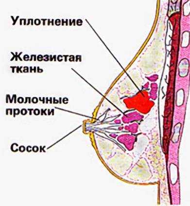Мастопатия: фиброзно кистозная и диффузная, лечение молочной железы в фнкц