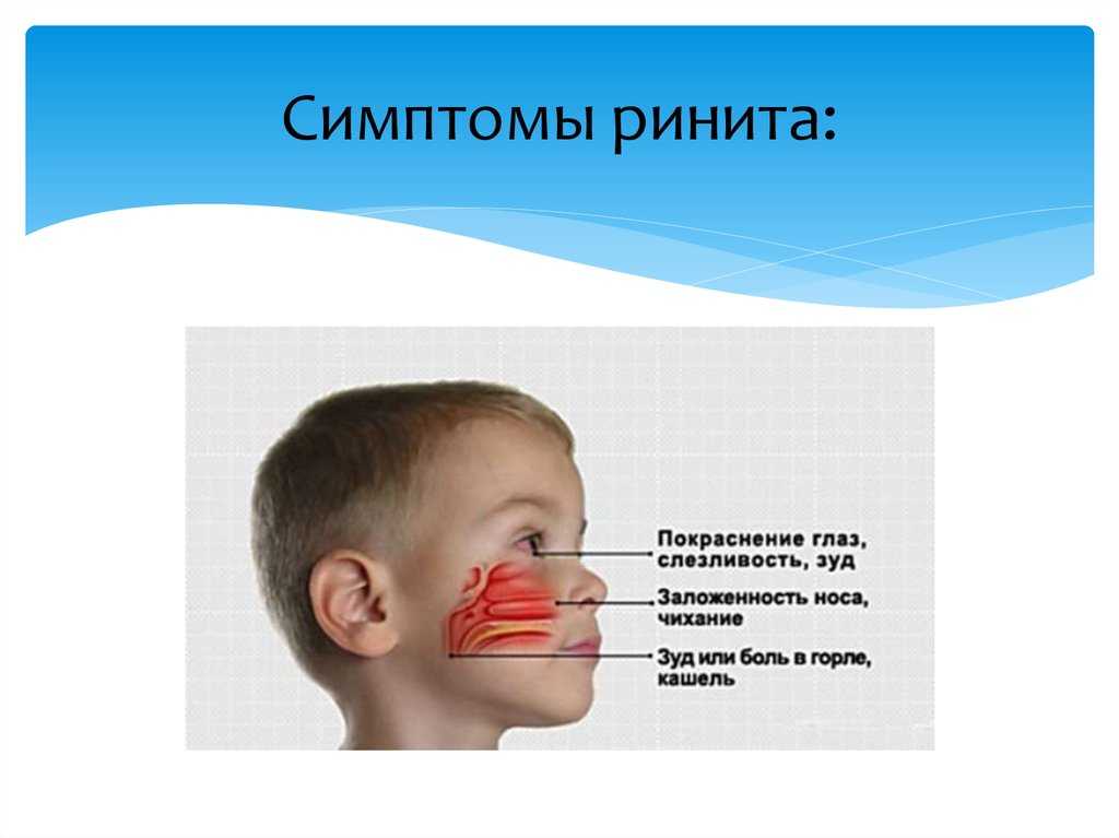 Первая помощь ребенку при насморке и заложенности носа