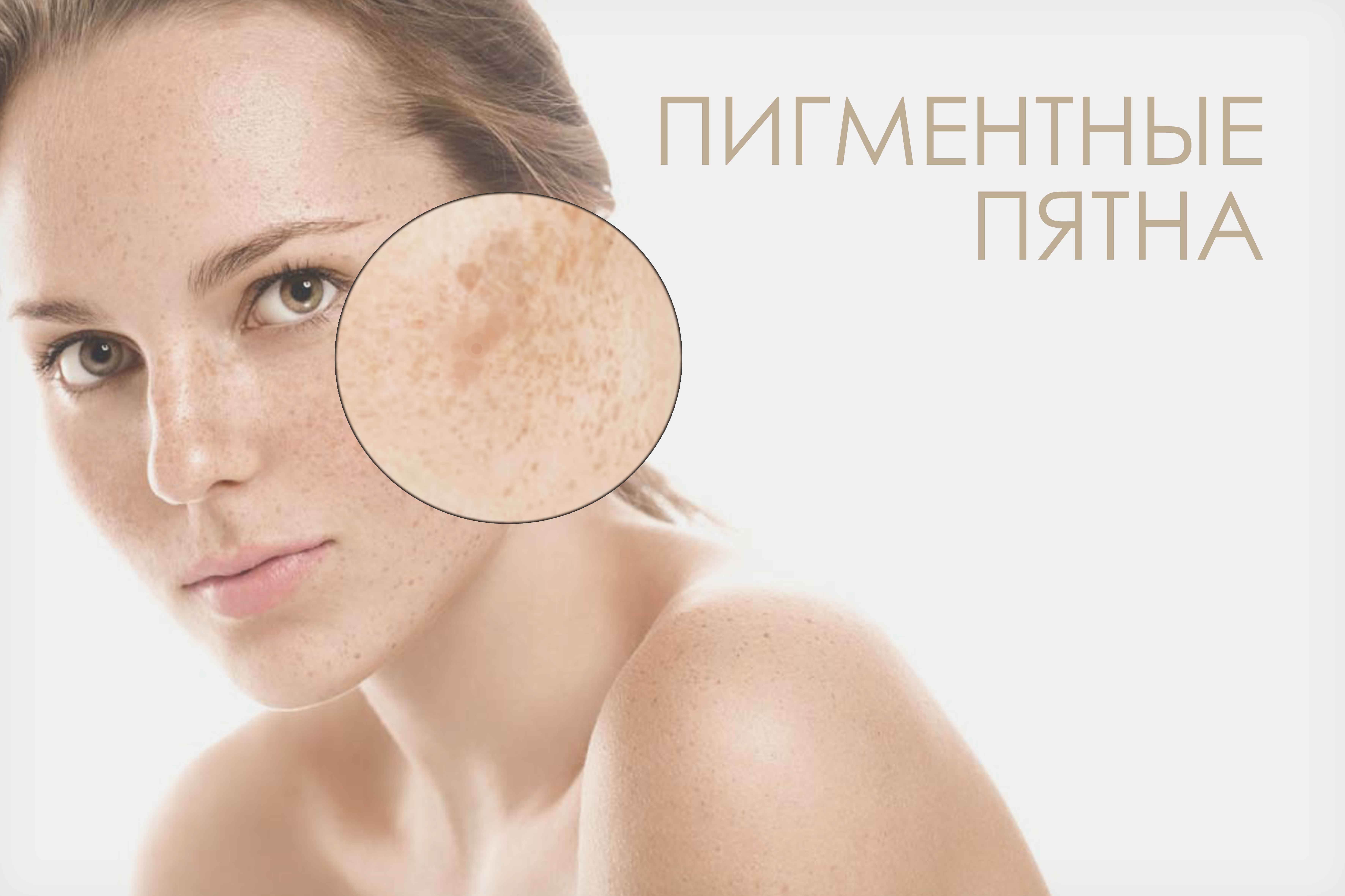 Депигментация кожи: главные причины и лечение | food and health